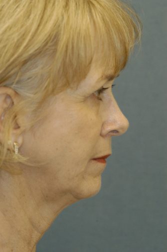 Chin Implant