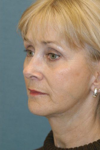 Chin Implant