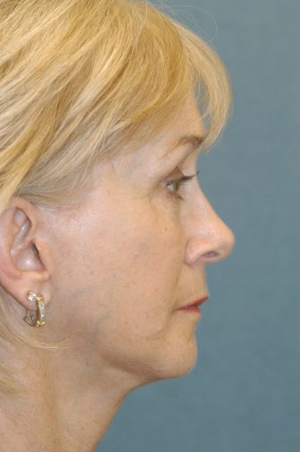 Chin Implant