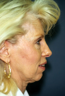 Chin Implant