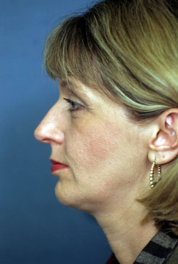 Chin Implant