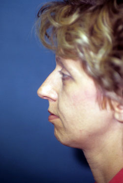 Chin Implant