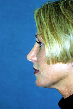 Chin Implant