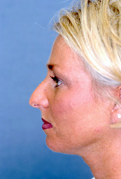 Chin Implant