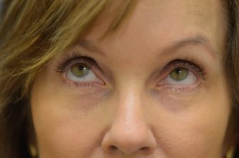 Lower Eyelid Blepharoplasty