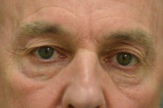 Upper Eyelid Blepharoplasty