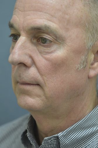 Lower Eyelid Blepharoplasty