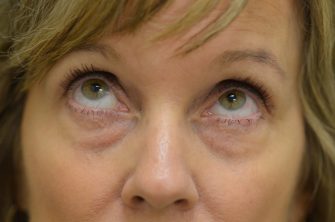 Lower Eyelid Blepharoplasty