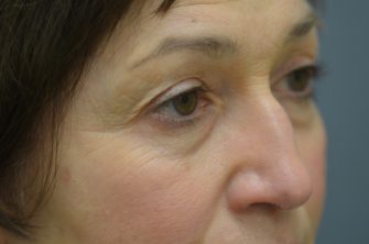 Lower Eyelid Blepharoplasty