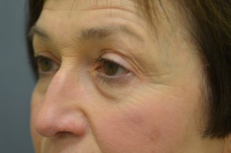 Lower Eyelid Blepharoplasty