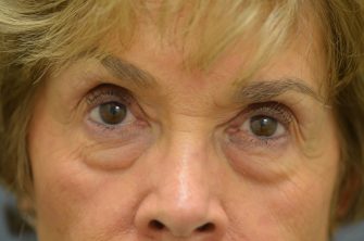 Lower Eyelid Blepharoplasty