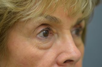 Lower Eyelid Blepharoplasty