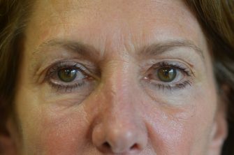 Lower Eyelid Blepharoplasty