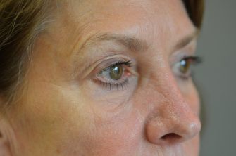 Lower Eyelid Blepharoplasty