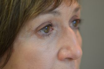 Upper Eyelid Blepharoplasty