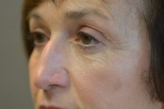 Lower Eyelid Blepharoplasty