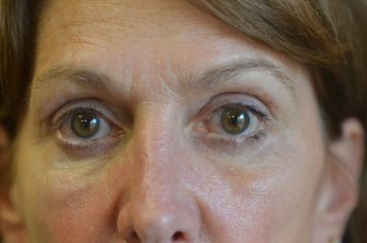 Lower Eyelid Blepharoplasty