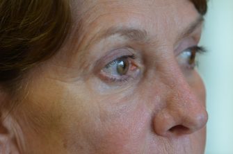 Upper Eyelid Blepharoplasty