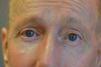 Lower Eyelid Blepharoplasty