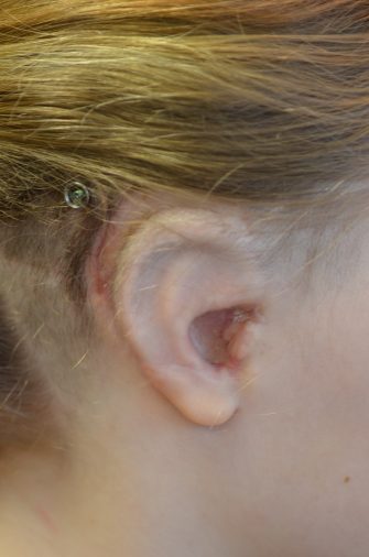 Ear Reconstruction (Microtia Reconstruction)