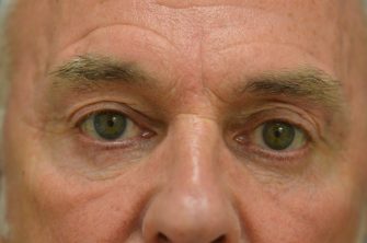 Upper Eyelid Blepharoplasty