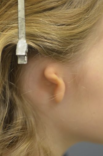 Ear Reconstruction (Microtia Reconstruction)