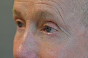 Lower Eyelid Blepharoplasty