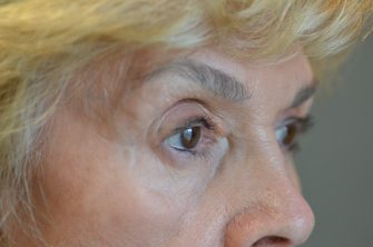 Lower Eyelid Blepharoplasty