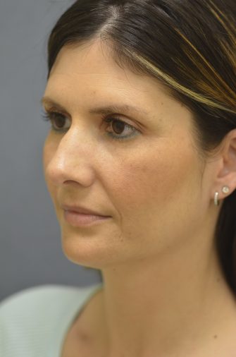 Juvederm