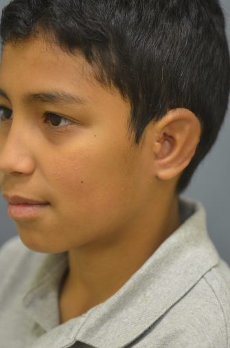 Ear Reconstruction (Microtia Reconstruction)