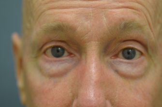 Lower Eyelid Blepharoplasty