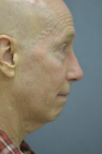 Chin Implant