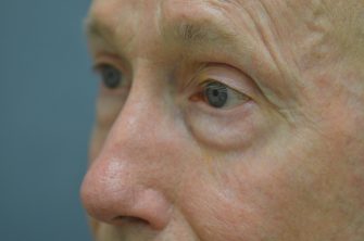 Lower Eyelid Blepharoplasty