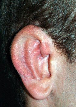 Ear Reconstruction (Microtia Reconstruction)