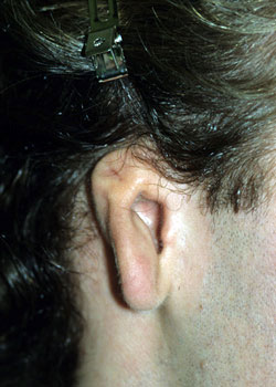 Ear Reconstruction (Microtia Reconstruction)