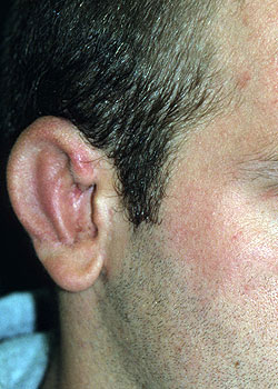 Ear Reconstruction (Microtia Reconstruction)