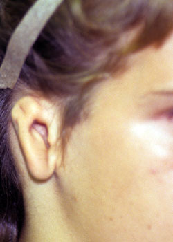 Ear Reconstruction (Microtia Reconstruction)