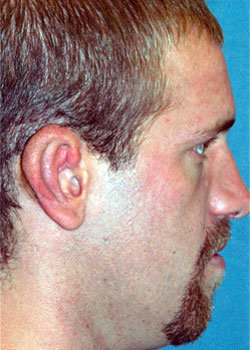 Ear Reconstruction (Microtia Reconstruction)