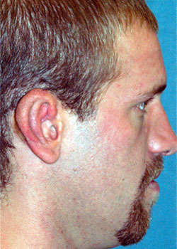 Ear Reconstruction (Microtia Reconstruction)