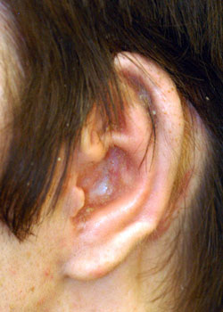 Ear Reconstruction (Microtia Reconstruction)