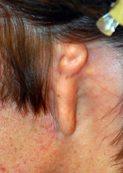 Ear Reconstruction (Microtia Reconstruction)