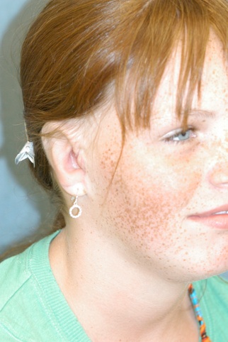 Ear Reconstruction (Microtia Reconstruction)