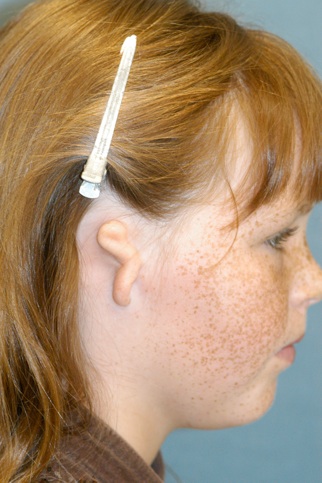 Ear Reconstruction (Microtia Reconstruction)