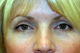 Lower Eyelid Blepharoplasty