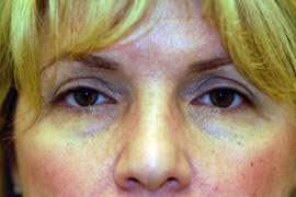 Lower Eyelid Blepharoplasty