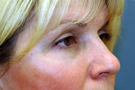 Lower Eyelid Blepharoplasty