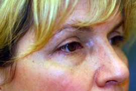 Lower Eyelid Blepharoplasty