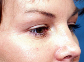 Lower Eyelid Blepharoplasty