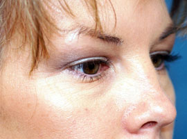 Lower Eyelid Blepharoplasty