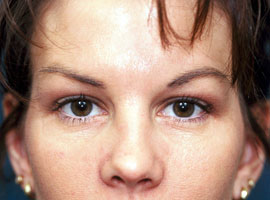 Lower Eyelid Blepharoplasty